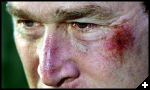 [bruise2]