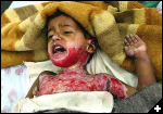 [bloody burnt baby]